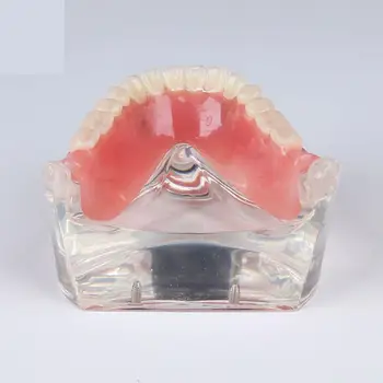 Стоматологическая модель для изучения зубов Overdenture Inferior 4 Демонстрационная модель имплантата
